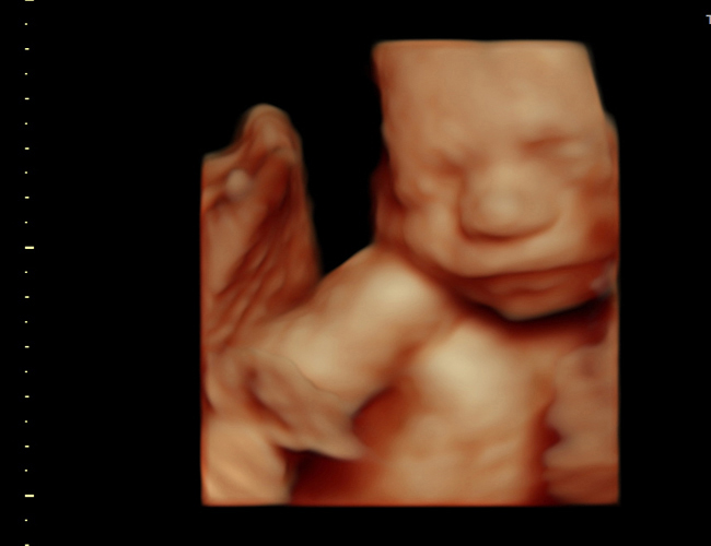 3D ultrasound image at 25 weeks